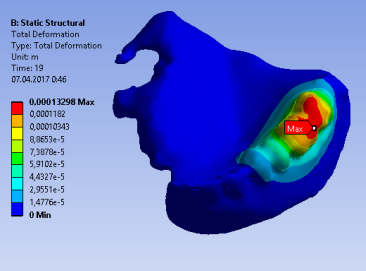 3D-модель пострзекционного протеза на верхнюю челюсть .png